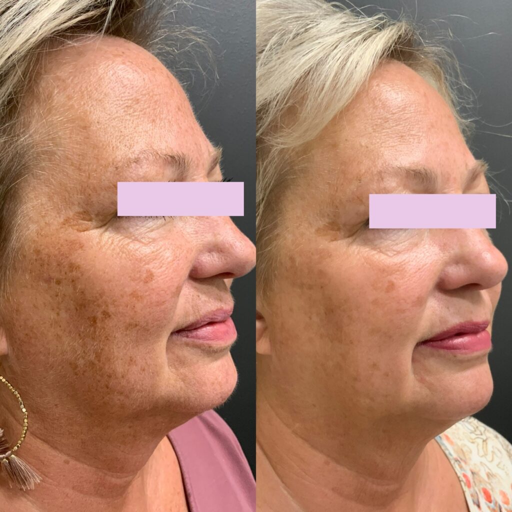 Limelight IPL before and after photo by Elite Dermatology & Plastic Surgery in Houston, TX