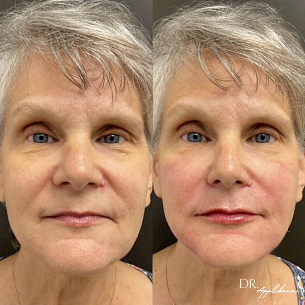 Full Facial Rejuvenation Filler before and after photo by Elite Dermatology & Plastic Surgery in Houston, TX