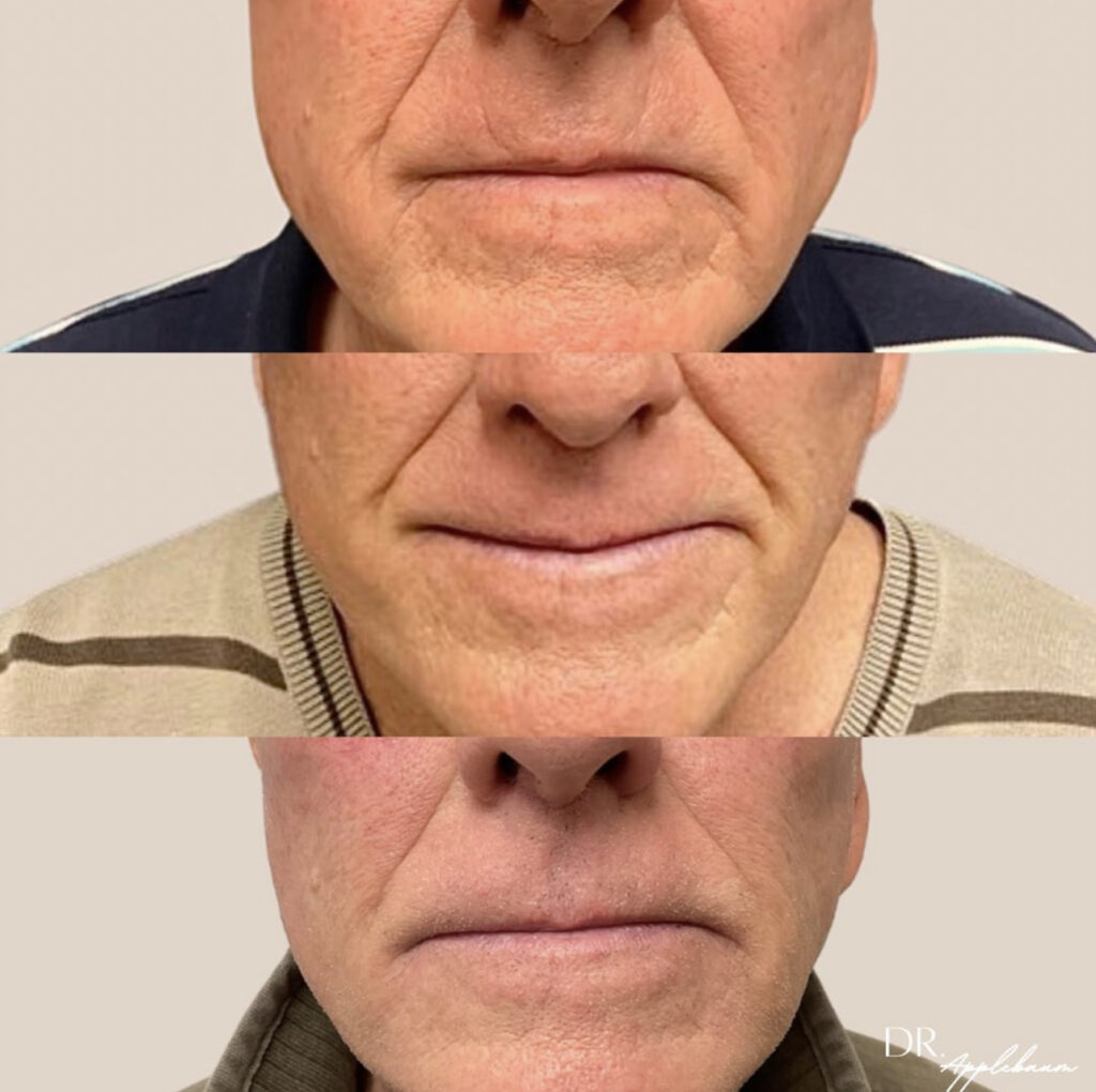 RHA & Redensity Filler before and after photo by Elite Dermatology & Plastic Surgery in Houston, TX