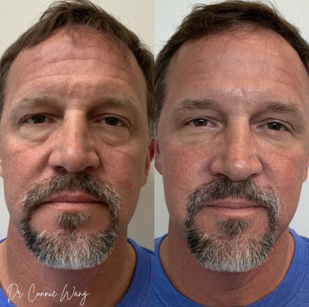 Skincare, Fillers, Botox, Skin Treatments before and after photo by Elite Dermatology & Plastic Surgery in Houston, TX