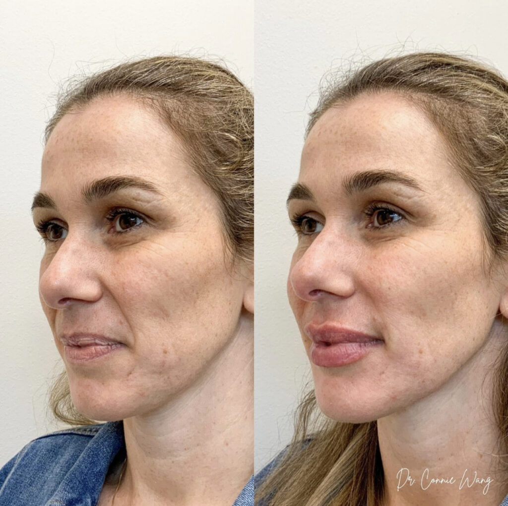 Lip & Nasolabial Folds Filler before and after photo by Elite Dermatology & Plastic Surgery in Houston, TX