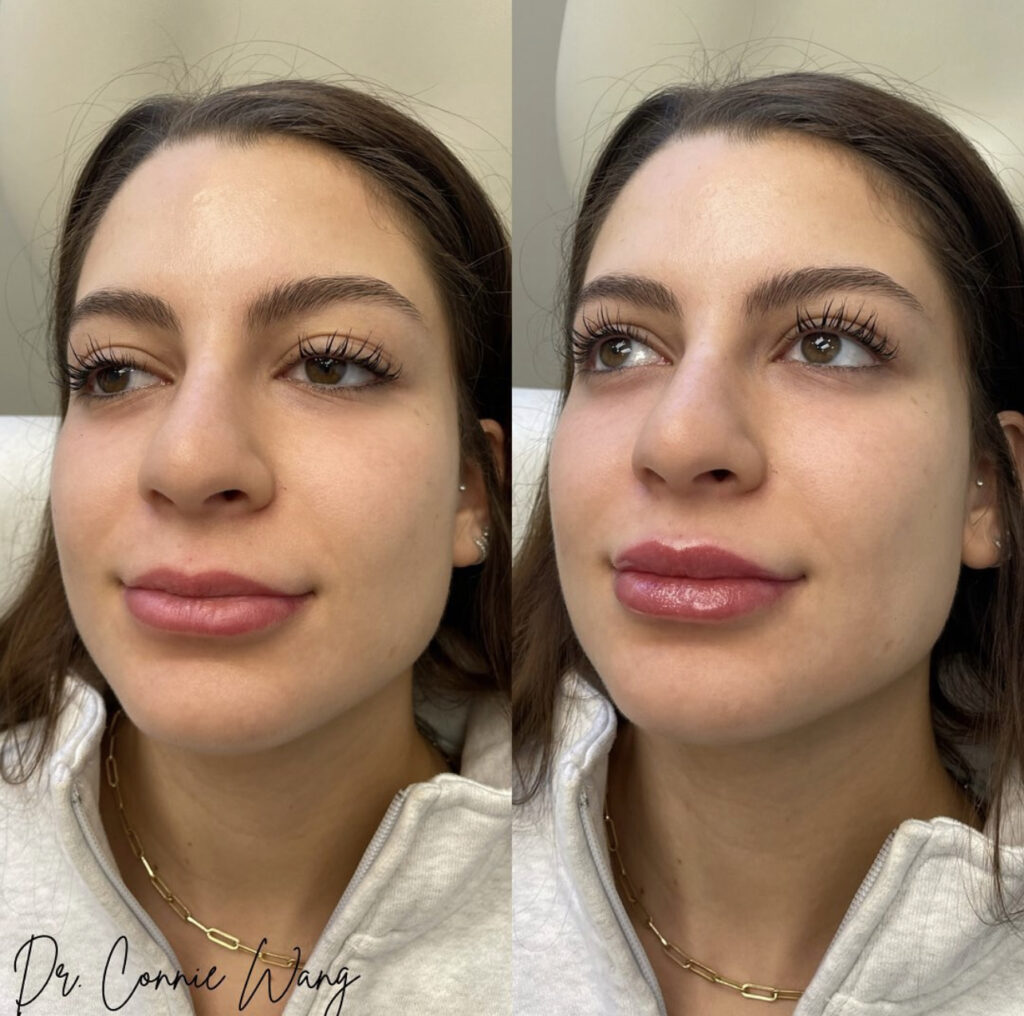 Lip Filler before and after photo by Elite Dermatology & Plastic Surgery in Houston, TX
