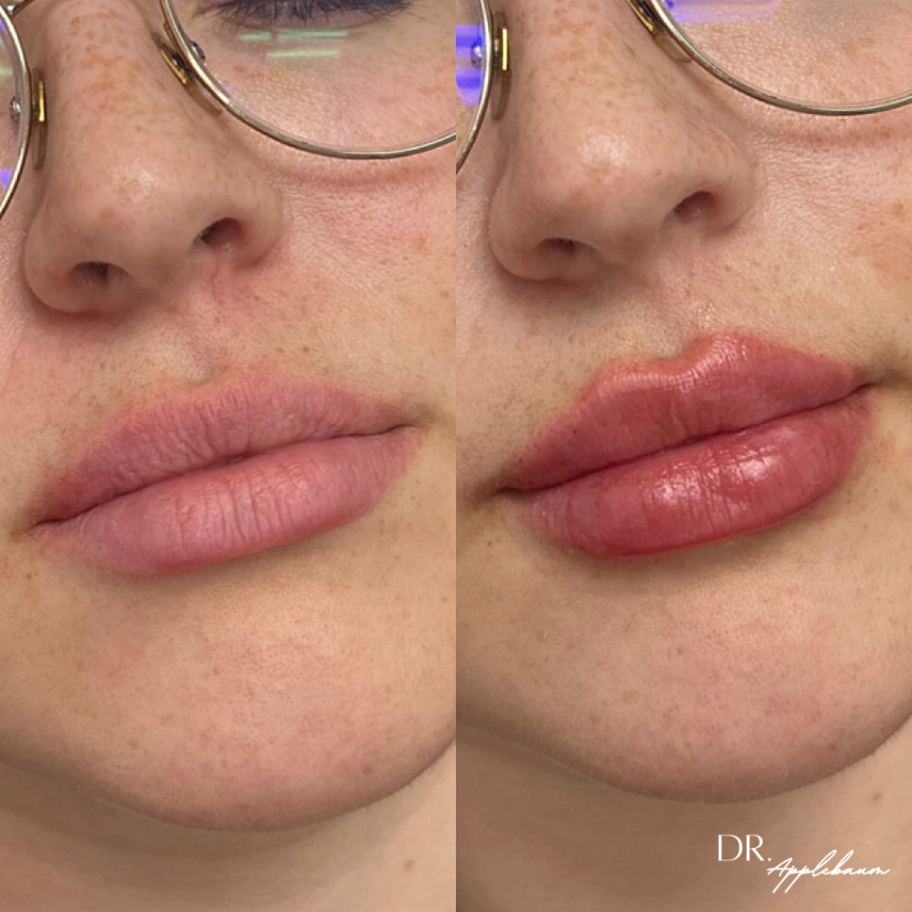 Restylane Kysse Lip Filler before and after photo by Elite Dermatology & Plastic Surgery in Houston, TX