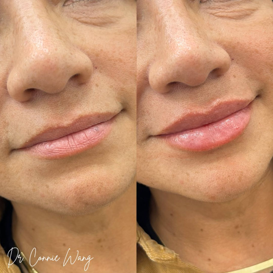 Restylane Refyne Lip Filler before and after photo by Elite Dermatology & Plastic Surgery in Houston, TX