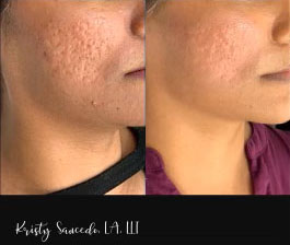 Secret RF before and after photo by Elite Dermatology & Plastic Surgery in Houston, TX