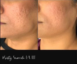 Secret RF before and after photo by Elite Dermatology & Plastic Surgery in Houston, TX