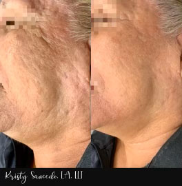 Secret RF before and after photo by Elite Dermatology & Plastic Surgery in Houston, TX