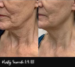 Secret RF before and after photo by Elite Dermatology & Plastic Surgery in Houston, TX