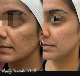 Secret RF before and after photo by Elite Dermatology & Plastic Surgery in Houston, TX