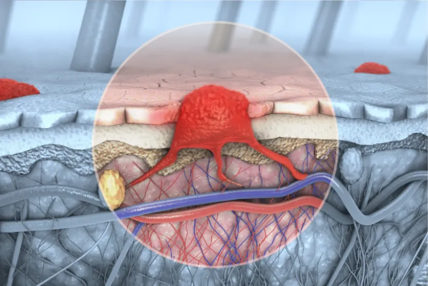 d illustration of a cross section of a diseased skin with melanoma that enters the bloodstream and lymphatic tract d illustration of a cross section of a diseased skin with melanoma that enters the bloodstream and lymphatic tract