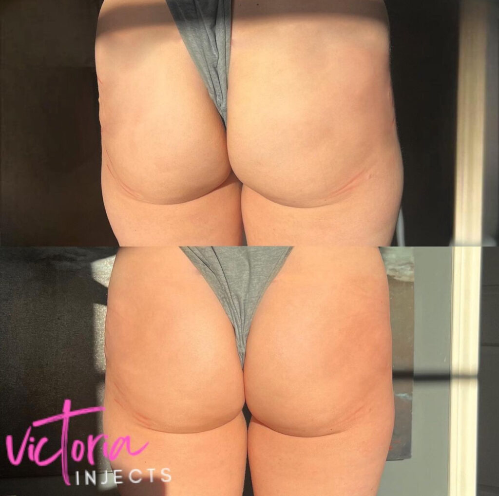Radiesse BBL before and after photo by Elite Dermatology & Plastic Surgery in Houston, TX
