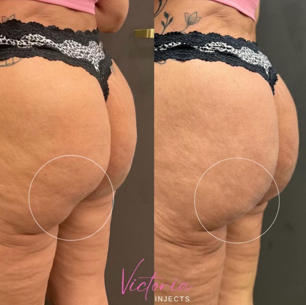 Radiesse BBL before and after photo by Elite Dermatology & Plastic Surgery in Houston, TX