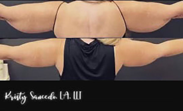 CoolSculpting® before and after photo by Elite Dermatology & Plastic Surgery in Houston, TX