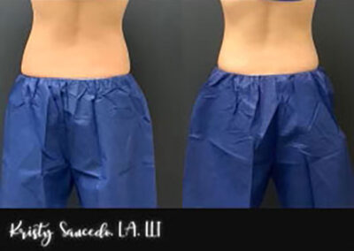 CoolSculpting® before and after photo by Elite Dermatology & Plastic Surgery in Houston, TX