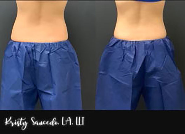 CoolSculpting® before and after photo by Elite Dermatology & Plastic Surgery in Houston, TX