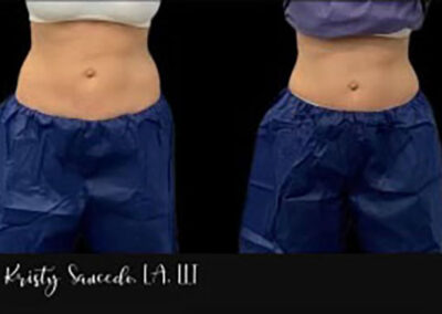 CoolSculpting® before and after photo by Elite Dermatology & Plastic Surgery in Houston, TX