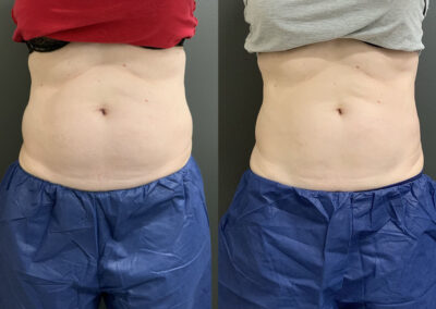 CoolSculpting® before and after photo by Elite Dermatology & Plastic Surgery in Houston, TX