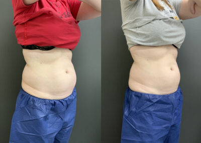 CoolSculpting® before and after photo by Elite Dermatology & Plastic Surgery in Houston, TX