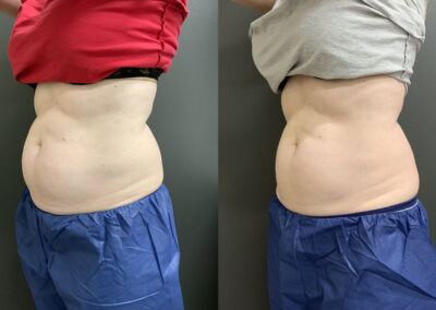 CoolSculpting® before and after photo by Elite Dermatology & Plastic Surgery in Houston, TX