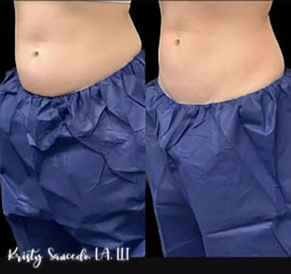 CoolSculpting® before and after photo by Elite Dermatology & Plastic Surgery in Houston, TX