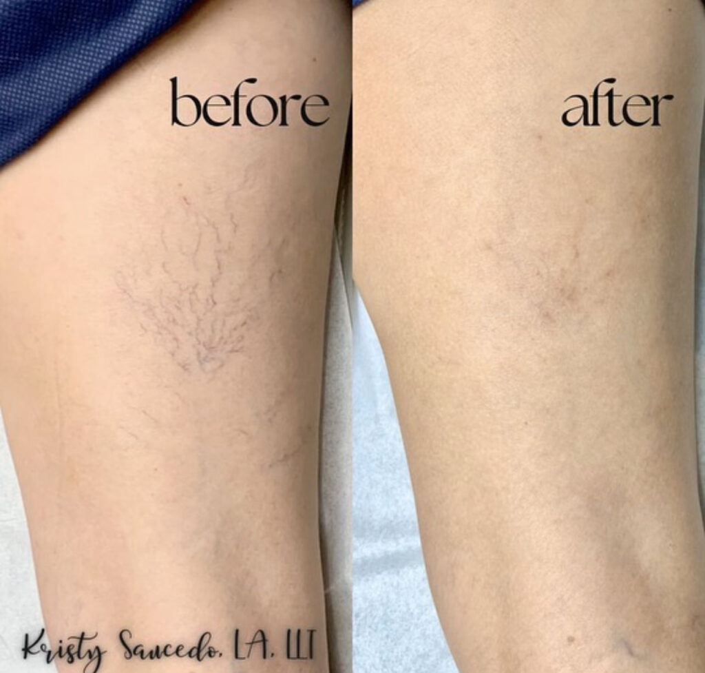 V Beam® before and after photo by Elite Dermatology & Plastic Surgery in Houston, TX