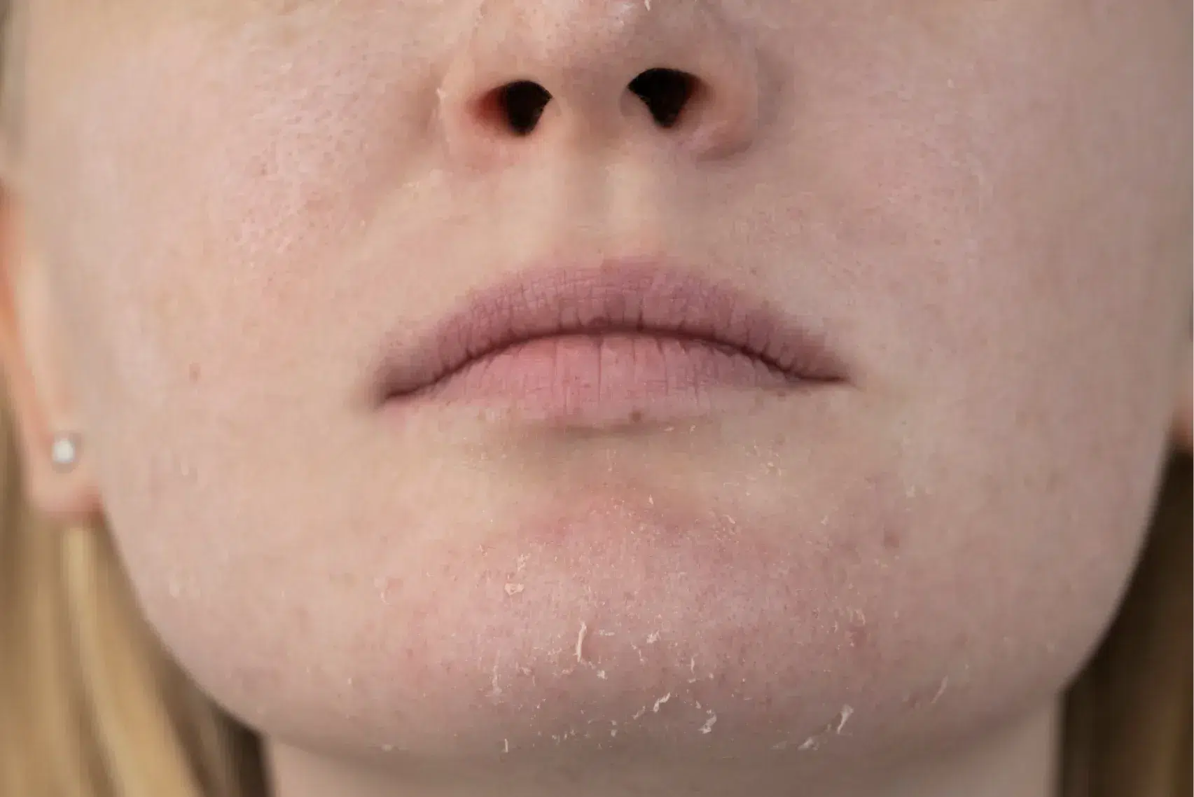 A woman examines dry skin on her face