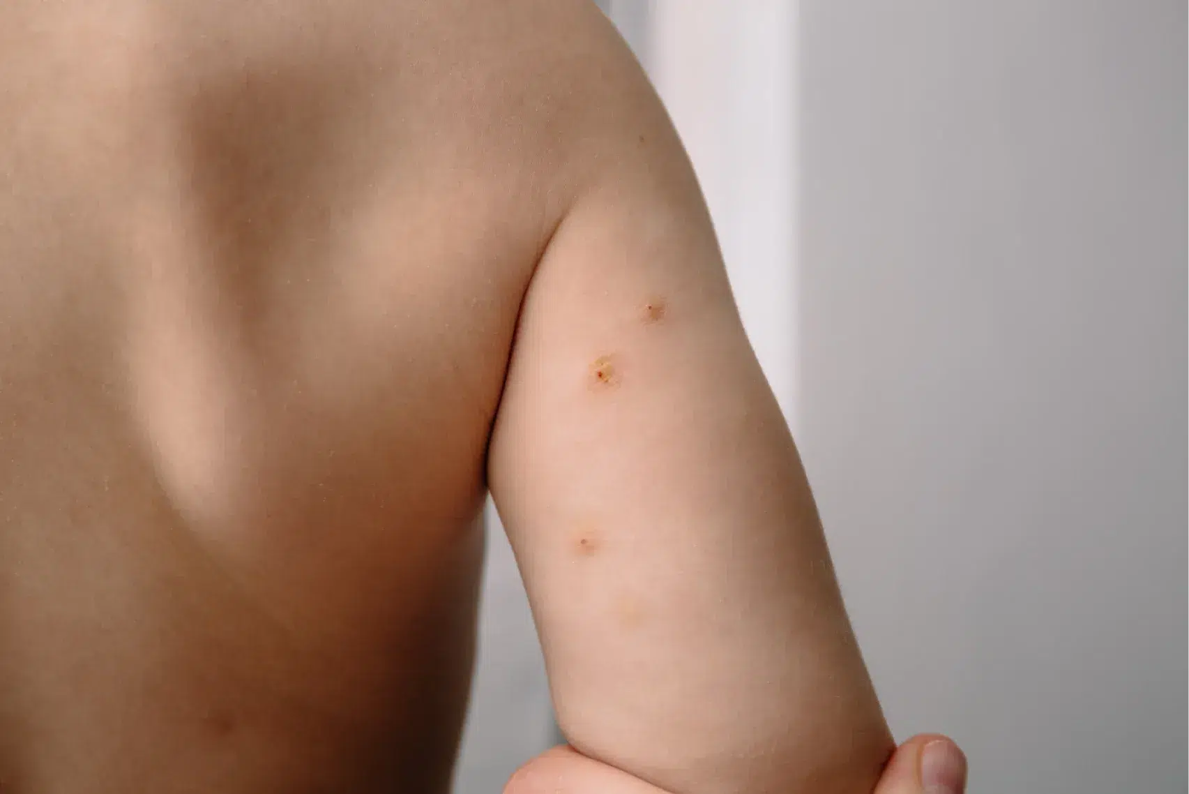 Close up of Molluscum Contagiosum also called water wart content image