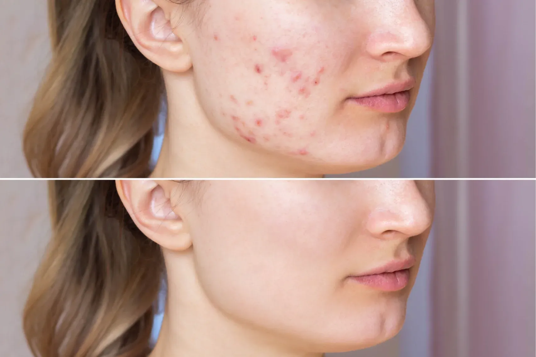 Cropped shot of a young woman's face before and after acne treatment on face acne content image