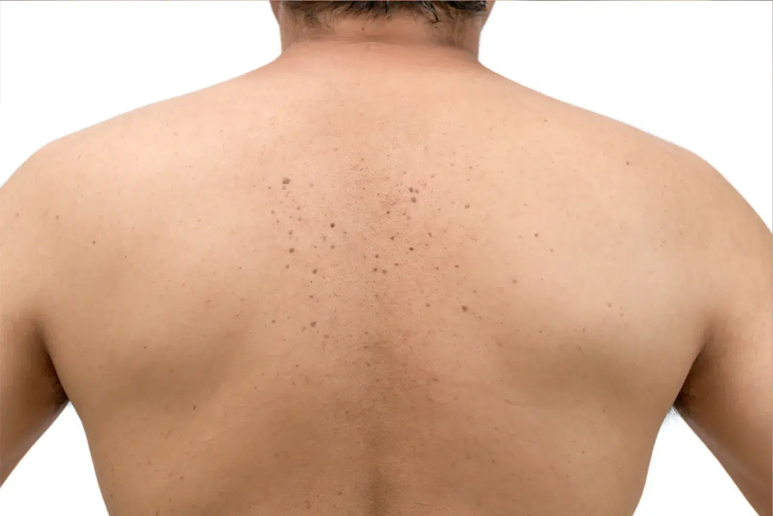 Seborrheic Keratosis on back content image