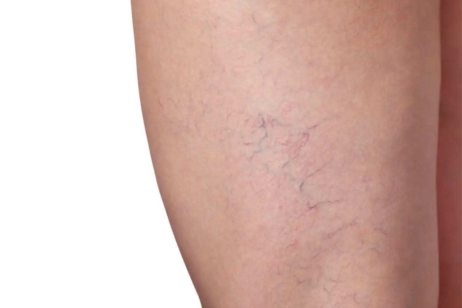Varicose veins and capillary veins in the legs content image Varicose veins and capillary veins in the legs content image