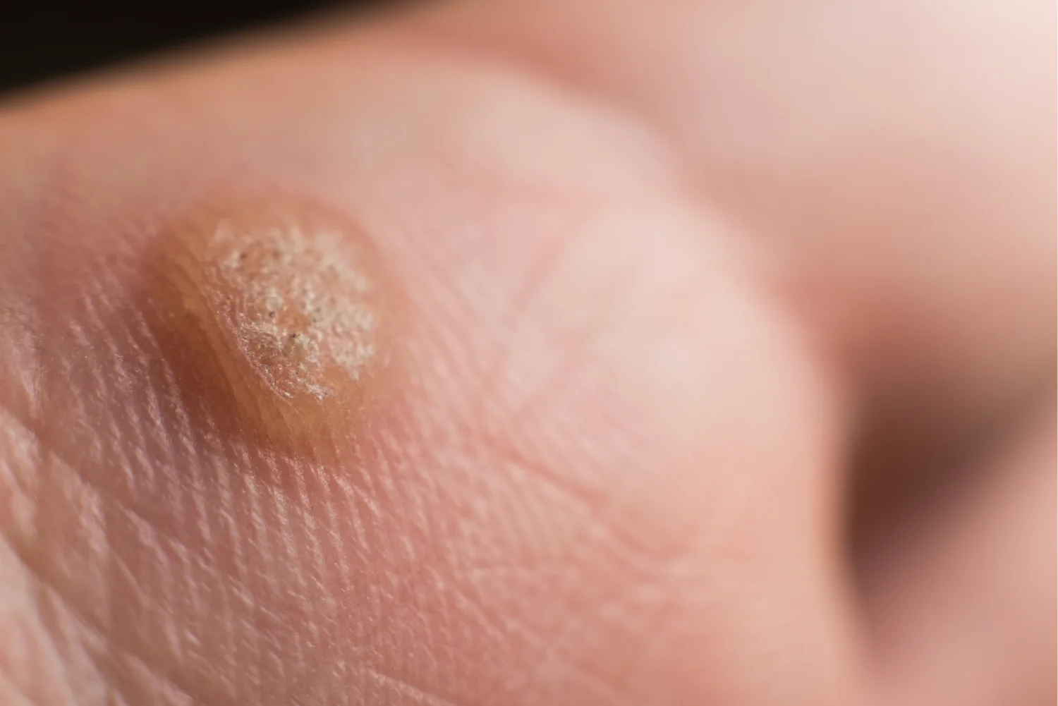 Verruca on hand, wart freeze concept, selective focus content image
