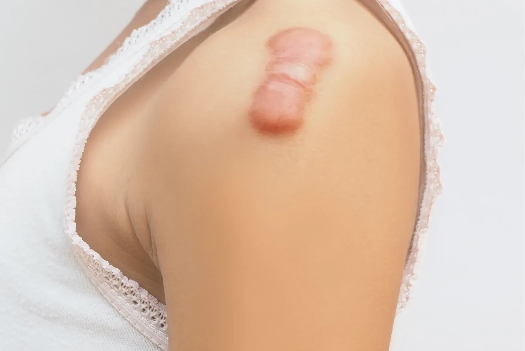 keloid scar of skin shoulder kid girl keloid content image