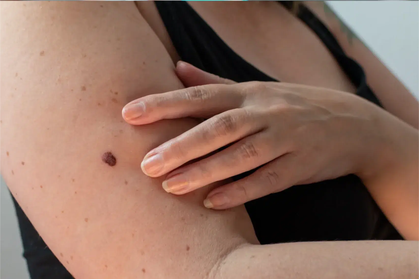 woman checking her skin for an abnormal mole for signs of melanoma skin cancer