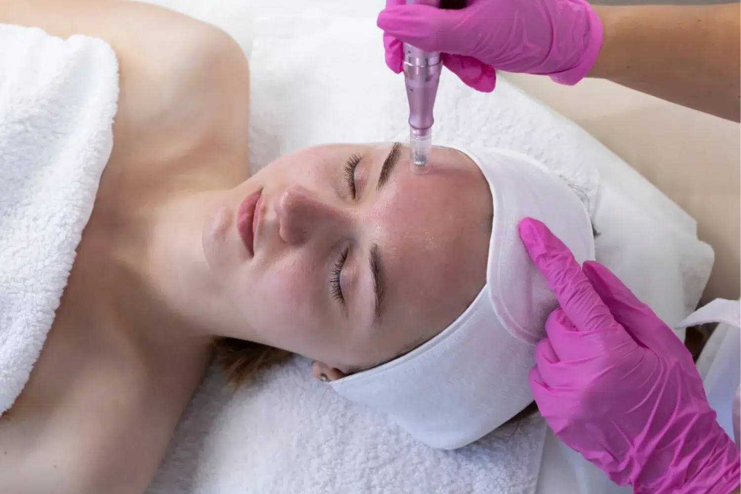 woman receiving skinpen treatment featured image