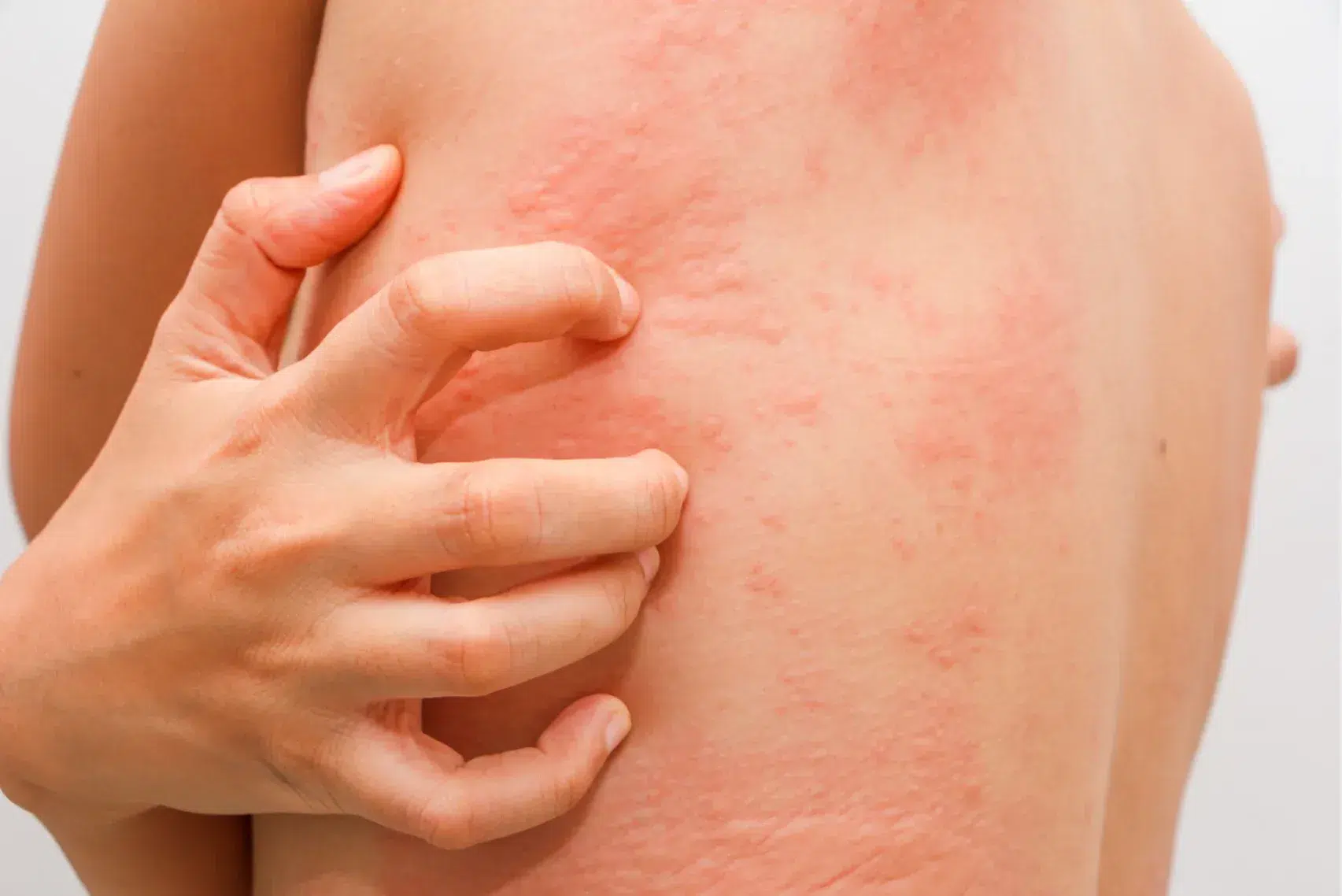woman with rash content image