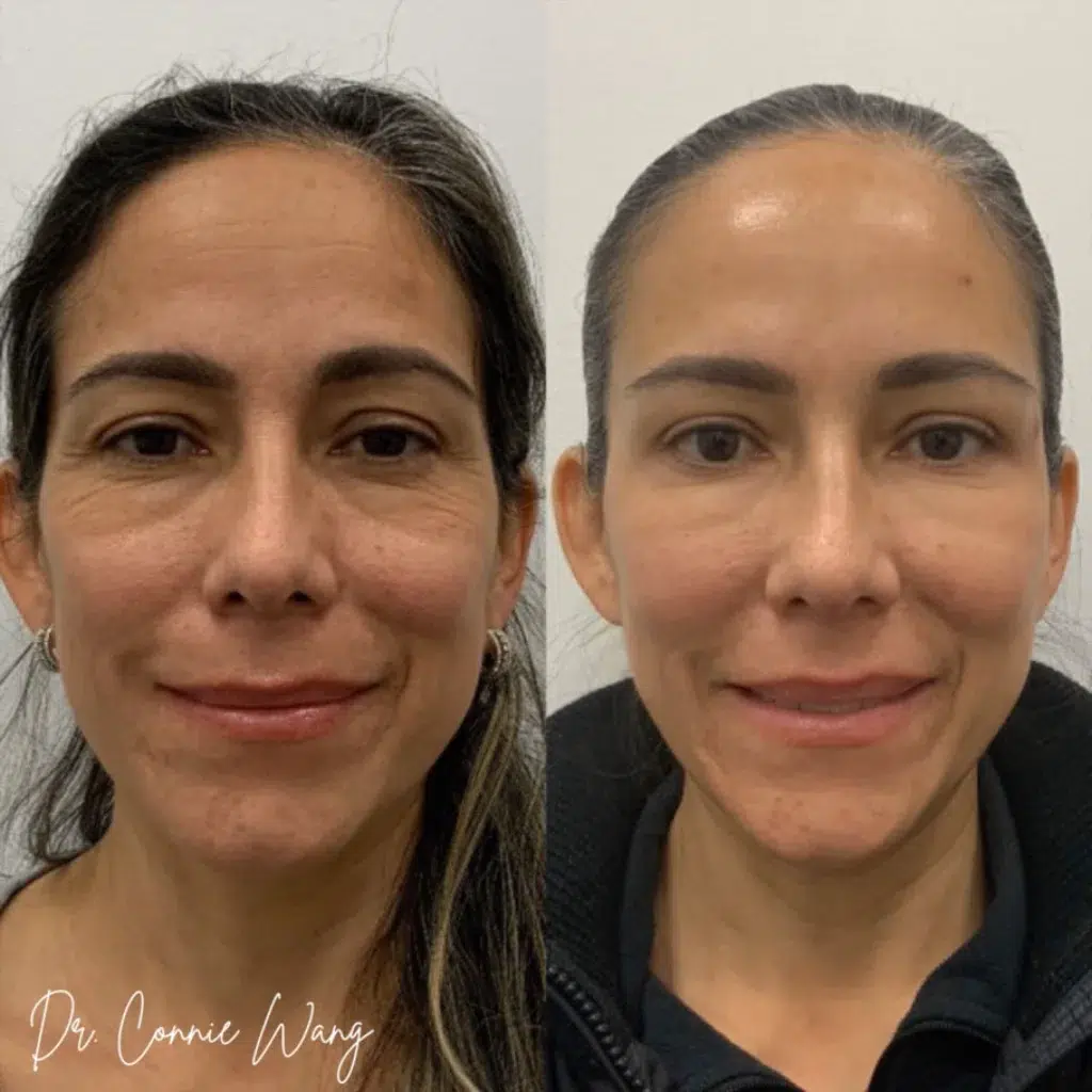 Dermal Fillers before and after photo by Elite Dermatology Plastic Surgery in Houston TX