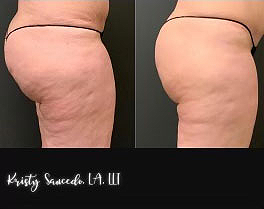 Trustsculpt Flex before and after photo by Elite Dermatology Plastic Surgery in River Oaks TX