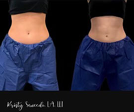 Trustsculpt Flex before and after photo by Elite Dermatology Plastic Surgery in River Oaks TX