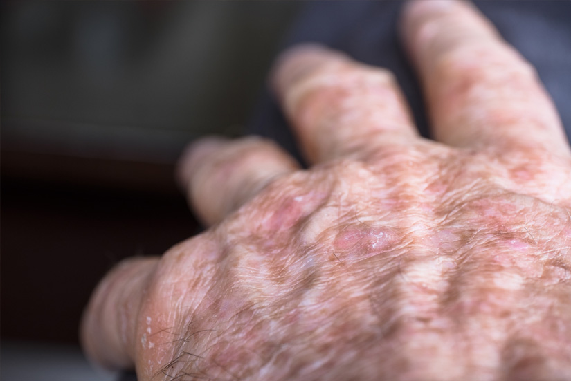 Lesions of actinic keratosis or sunspots on sun-damaged skin of the hand of a man. This can be treated with cryosurgery or certain ointments Lesions of actinic keratosis or sunspots on sun-damaged skin of the hand of a man. This can be treated with cryosurgery or certain ointments
