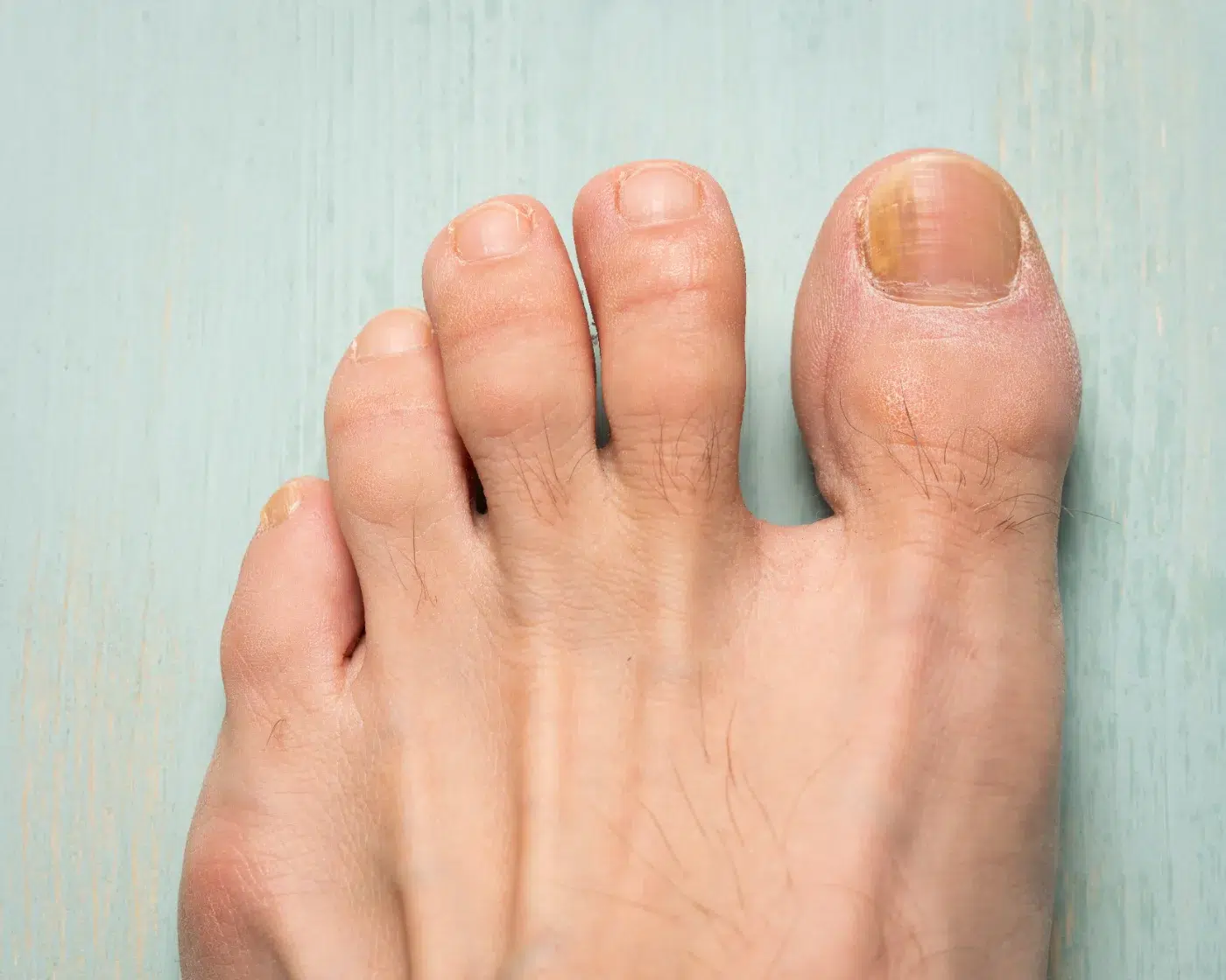 Toenails with fungus problems