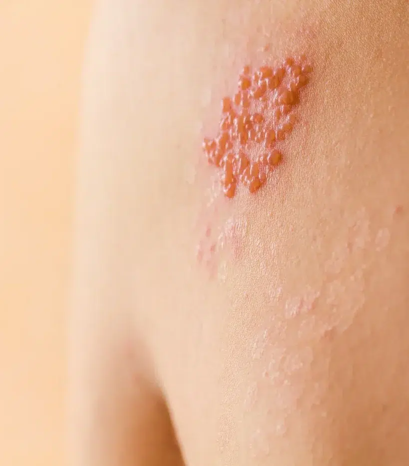 shingles on a man ()