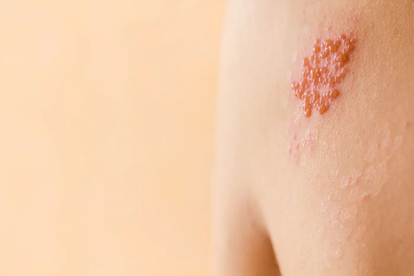 shingles on a man