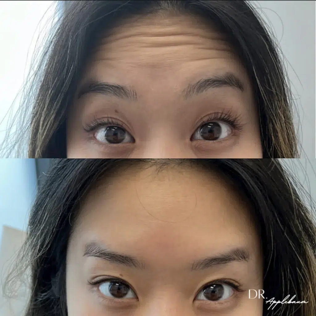 Botox (Daxxify) before and after photo by Elite Dermatology Plastic Surgery in Houston, TX