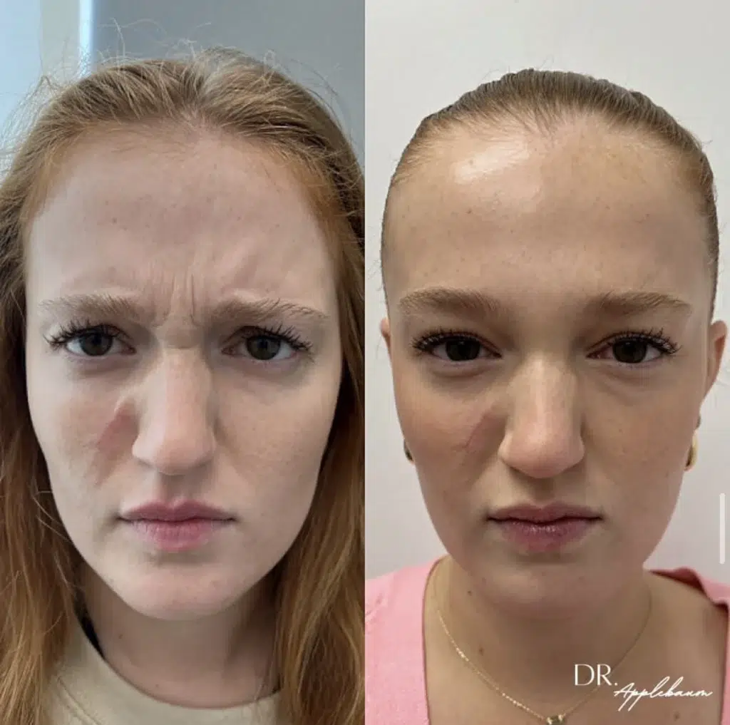 Botox (Daxxify) before and after photo by Elite Dermatology Plastic Surgery in Houston, TX