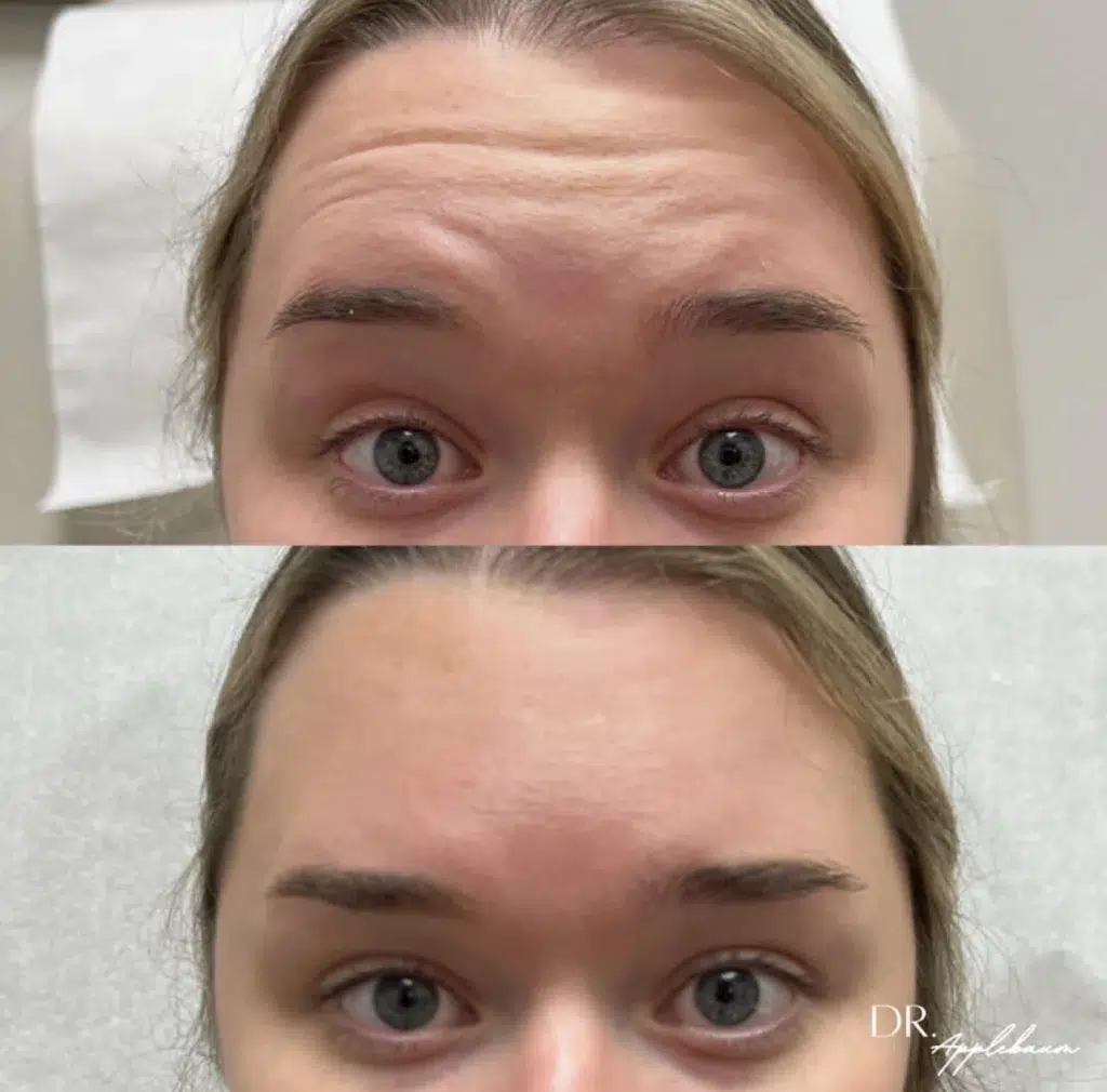 Botox before and after photo by Elite Dermatology Plastic Surgery in Houston, TX