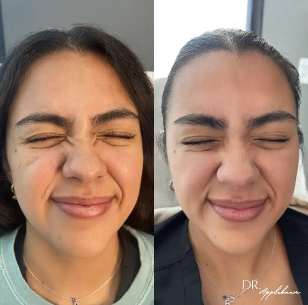 Botox before and after photo by Elite Dermatology Plastic Surgery in Houston, TX