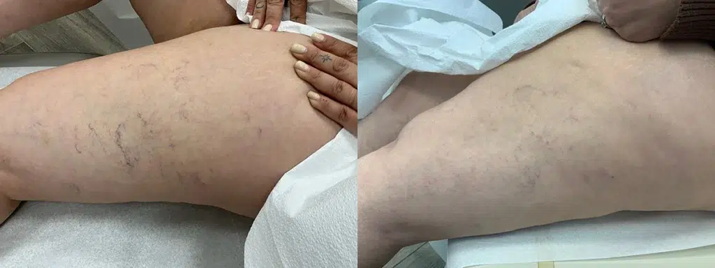 Sclerotherapy before and after photo by Elite Dermatology Plastic Surgery in Houston, TX