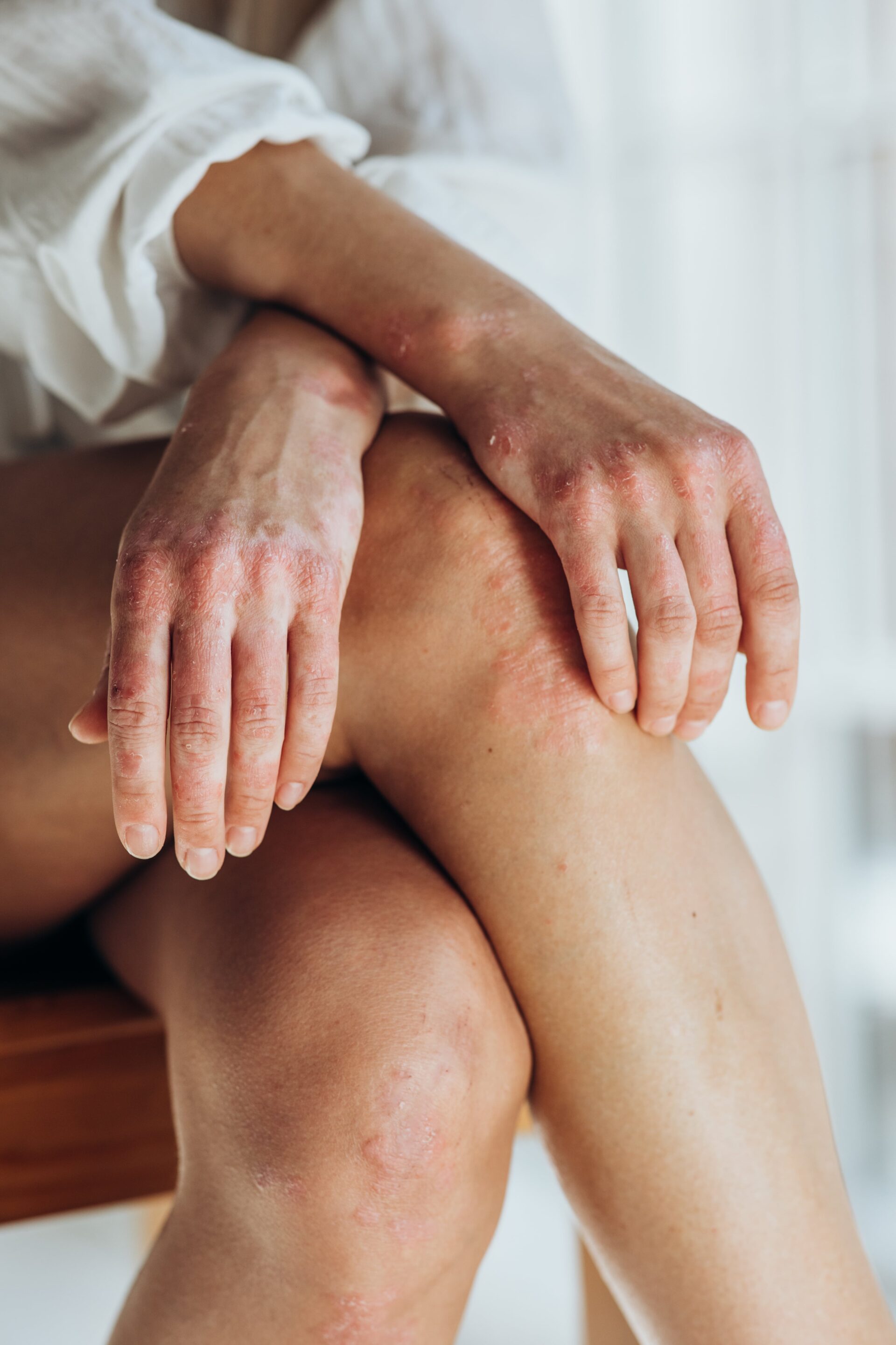 Psoriasis. Acute psoriasis