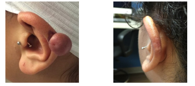 large Helix Keloid