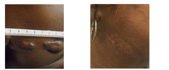 Angle of Mandible Keloid